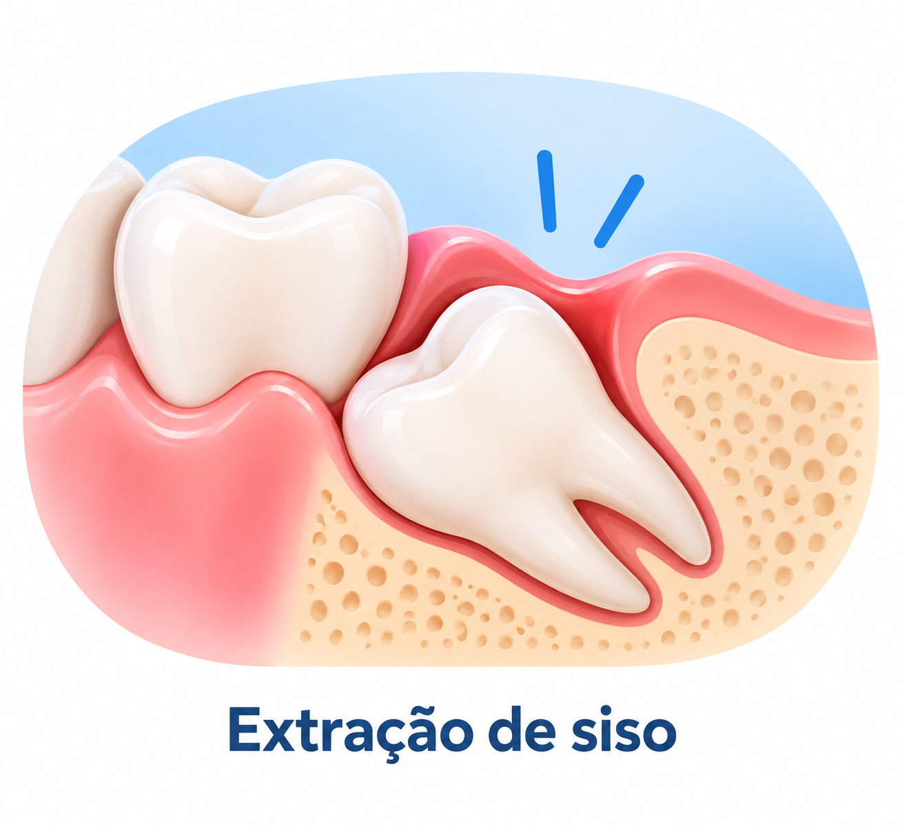 Extração de siso