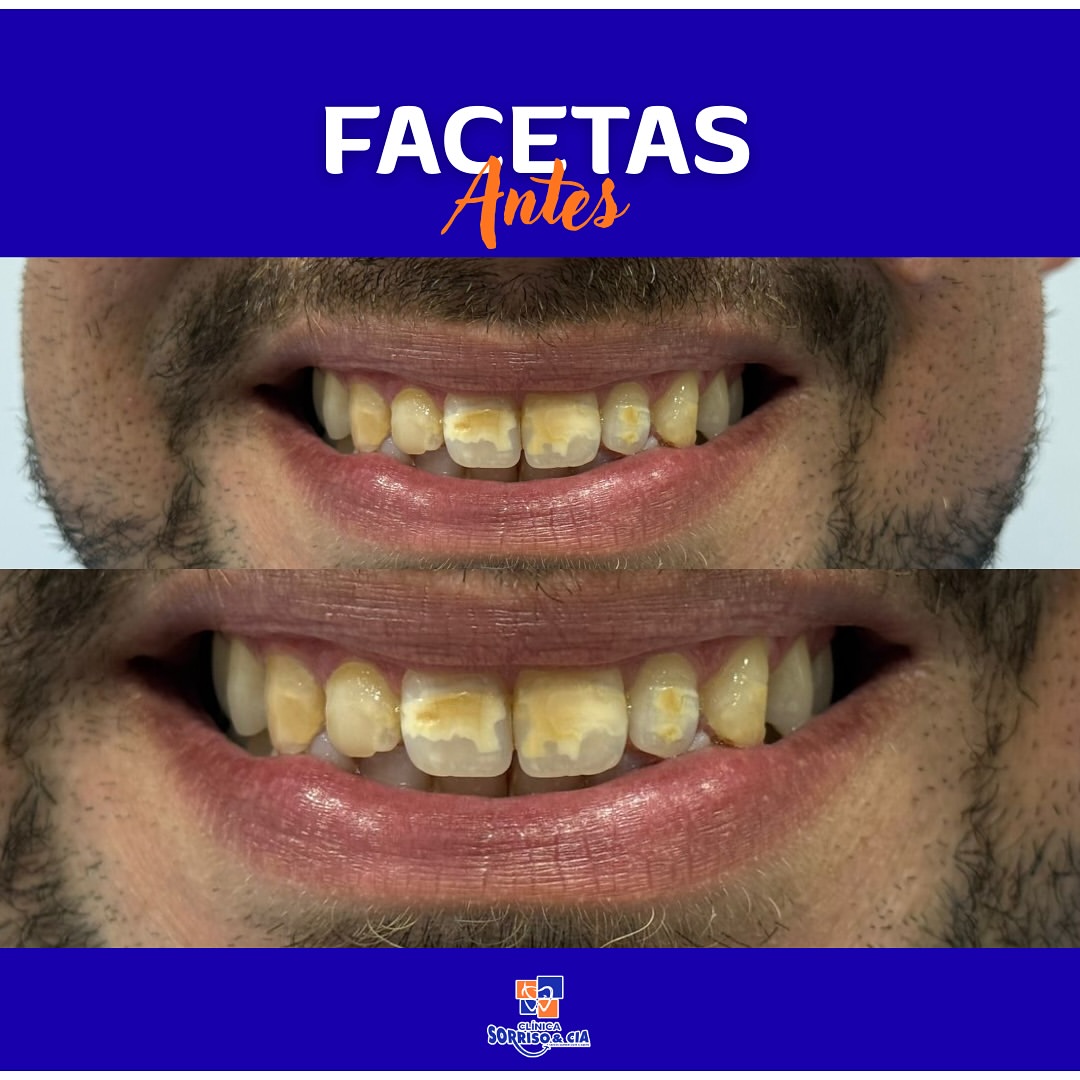 Facetas dentárias — Antes