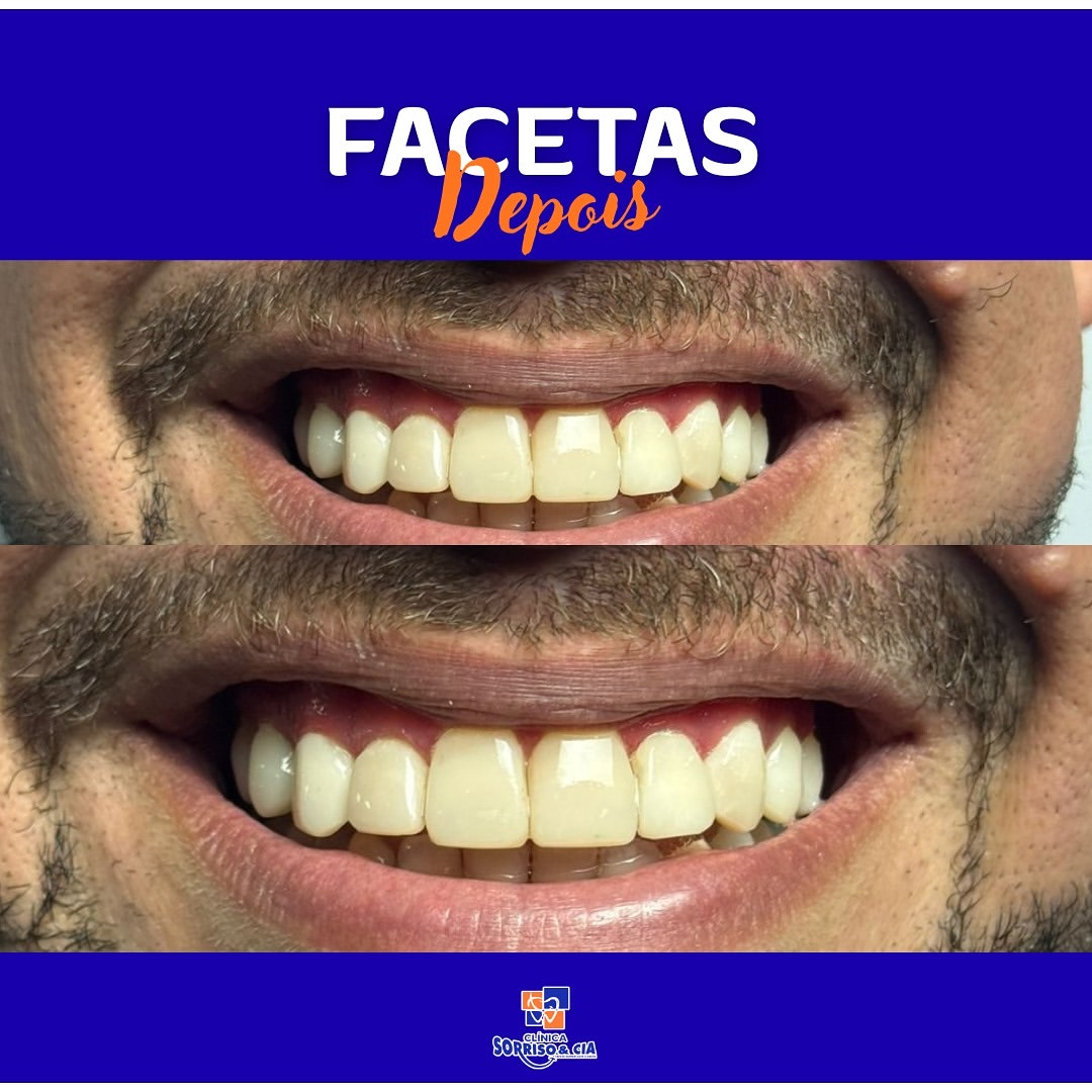 Facetas dentárias — Depois