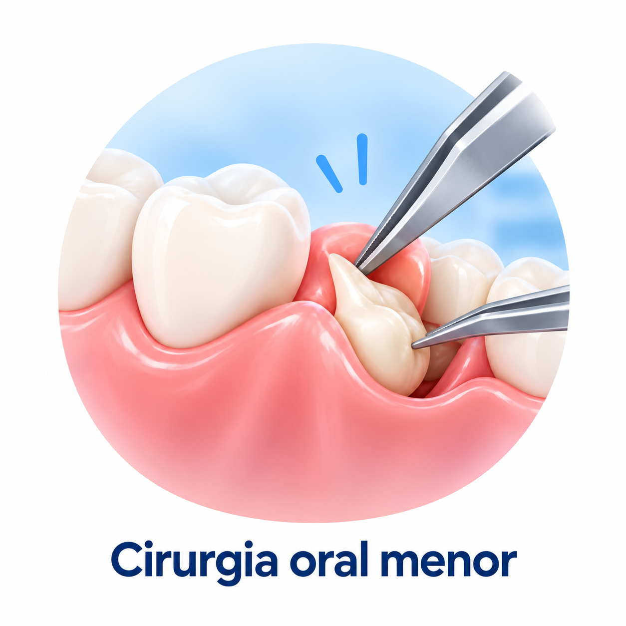 Cirurgia oral menor