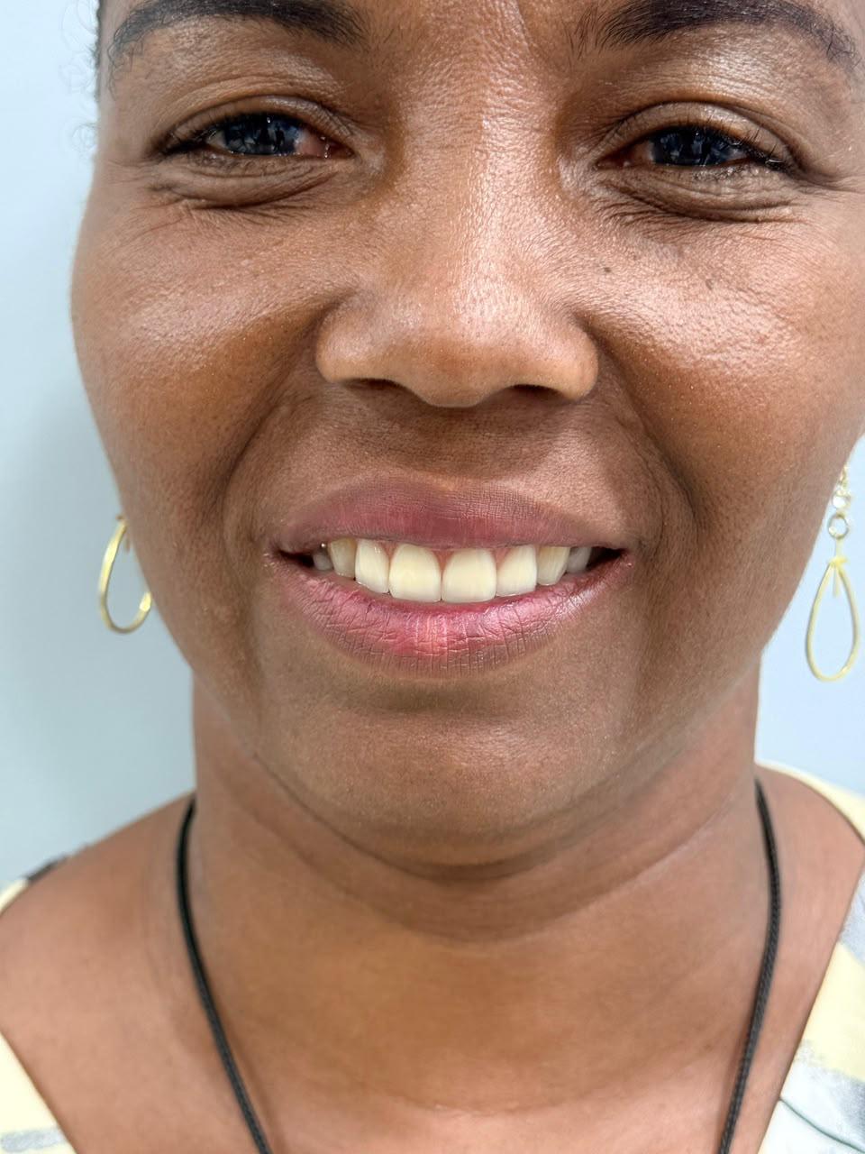 Reabilitação do sorriso — Depois