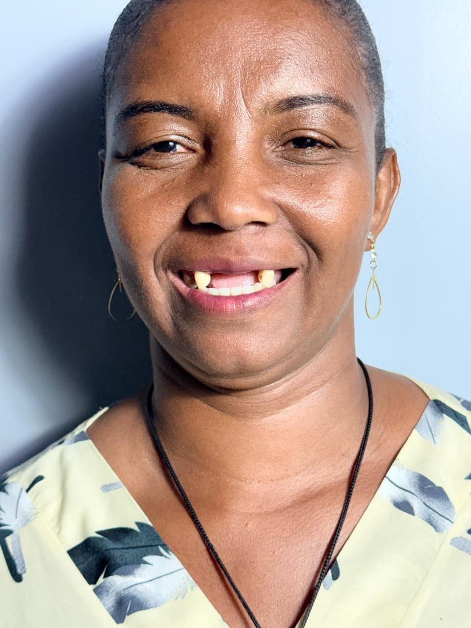 Reabilitação do sorriso — Antes